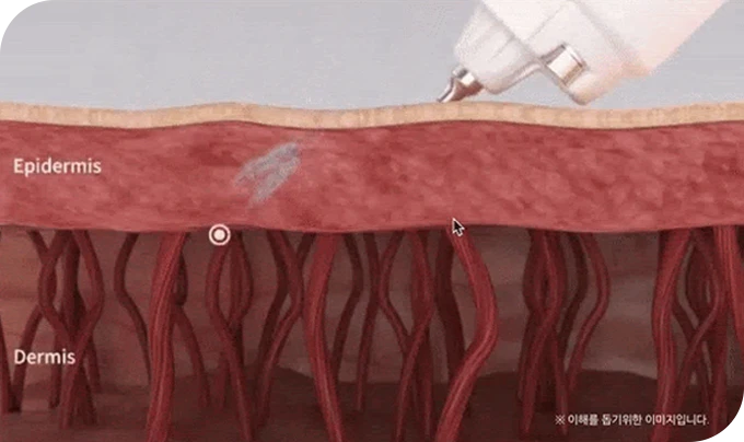 큐어젯 시술 원리 이미지